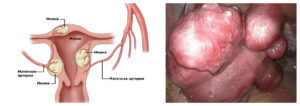 Лечится ли миома матки