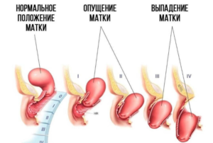 Почему опускается матка