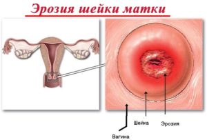 Кровит шейка матки при беременности