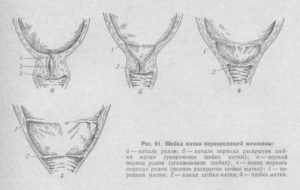 Как выглядит раскрытие шейки матки перед родами