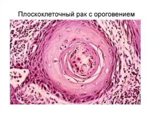 Плоскоклеточный ороговевающий рак шейки матки