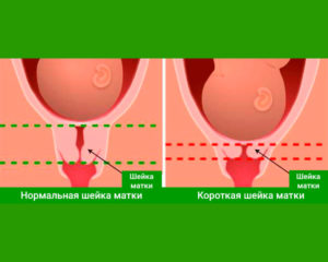 Симптомы укорочения шейки матки при беременности