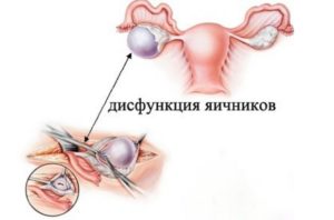 Дисфункция яичников: симптомы и методы лечения