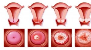 Что значит коническая шейка матки