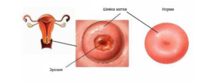 Как выглядит здоровая шейка матки