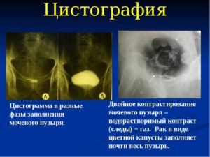 Цистограмма как делают детям