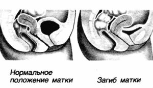 Поза для зачатия при загибе матки кзади