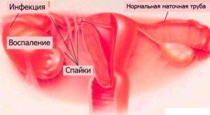 Маточные трубы не лоцируются что это значит