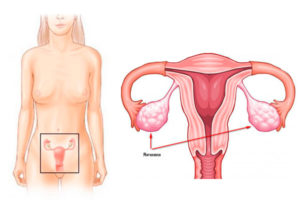 Симптомы проблем с яичниками у женщины