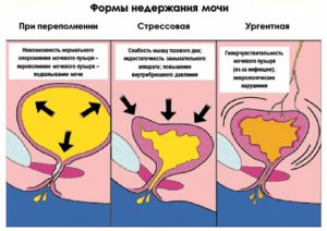 Подтекание мочи у женщин причины