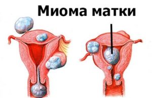 Какие выделения бывают при миоме матки