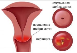 Беременность при хроническом цервиците
