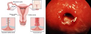 Цервицит шейки матки