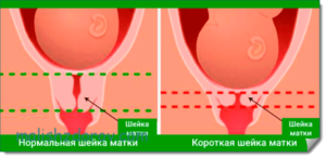 Что значит и чем грозит короткая шейка матки