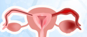 Кровотечение при кисте яичника: что делать