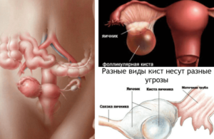 Ретенционное образование левого яичника что это такое