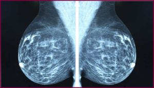 Как часто можно делать маммографию