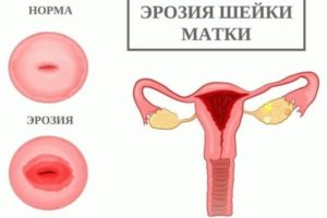 Почему из матки выходит воздух