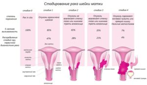 Стадии рака шейки матки