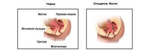 Что называют вентрофиксацией матки