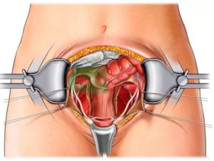 Последствия после удаления миомы матки
