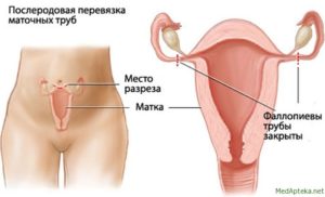 Как перевязывают маточные трубы