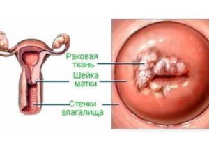 Кондиломы на шейке матки