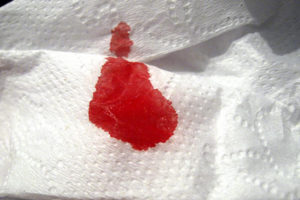 Выделения и сгустки крови из матки