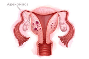 Миома и аденомиоз матки у женщин