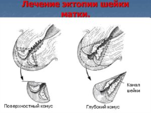 Что значит коническая шейка матки