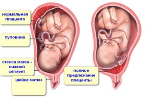 Плод прикреплен к задней стенки матки