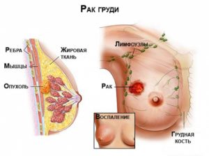 Опухоль в грудине у женщин