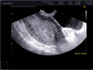 Когда лучше делать узи матки