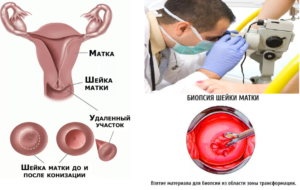 Биопсия шейки матки последствия