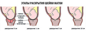 Свечи для размягчения шейки матки