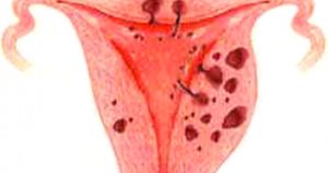Что такое аденоматоз эндометрия