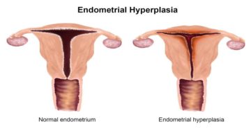 Выскабливание при гиперплазии эндометрия
