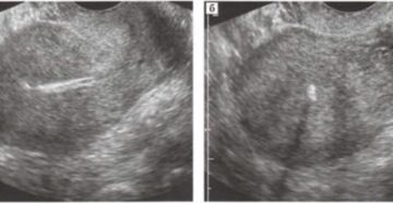 Что такое гиперэхогенные включения в матке