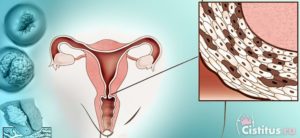 Причины и лечение гипертрофии шейки матки