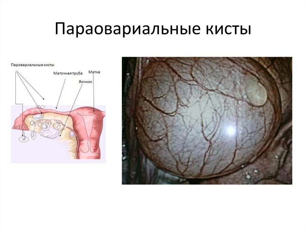 Параовариальная киста яичника: лечение без операции