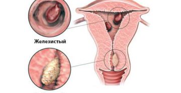 Виды полипов в матке