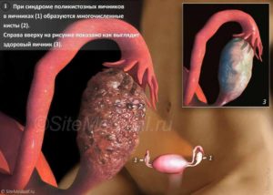 Поликистоз яичников: симптомы и лечение народными средствами