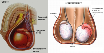 Орхит у ребенка