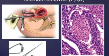 Диагностическое выскабливание полости матки при гиперплазии эндометрия