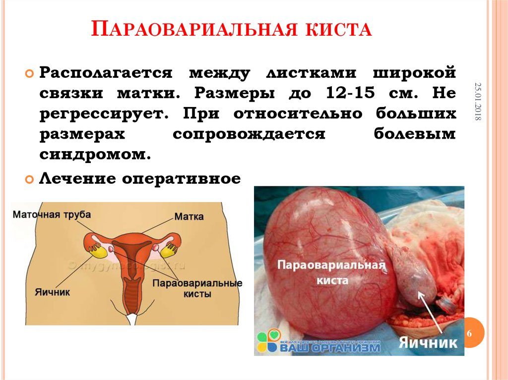 Паратубарная киста что это такое