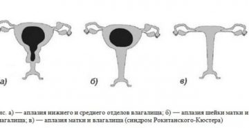 Лечение аплазии матки и ее шейки