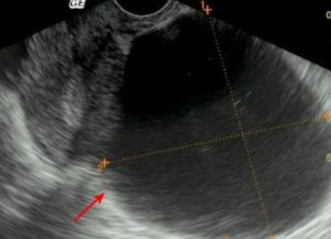 Что такое анэхогенное образование в шейке матки