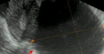 Что такое анэхогенное образование в шейке матки