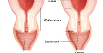 Стеноз цервикального канала