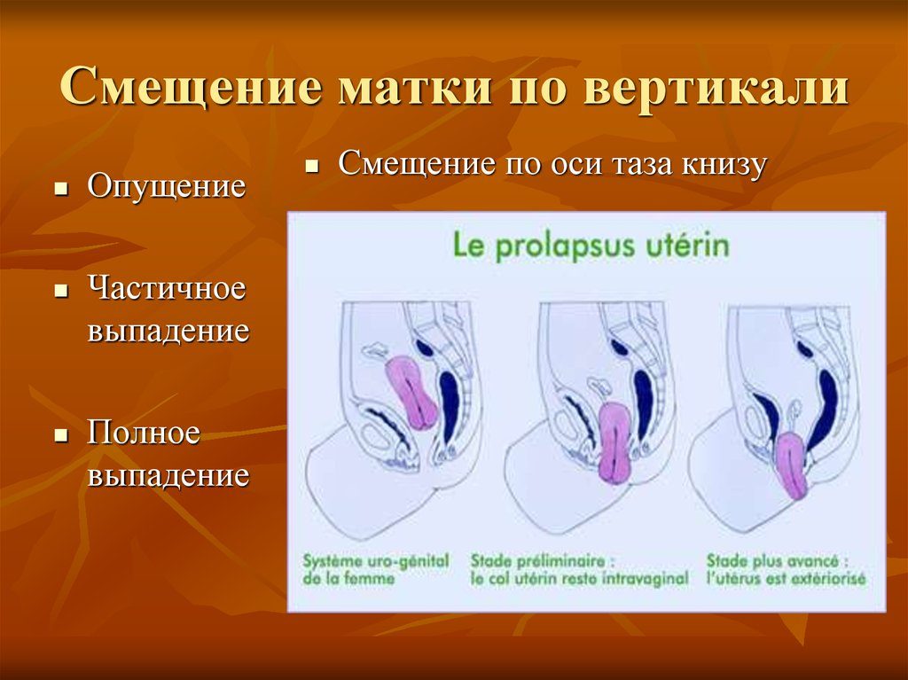 Смещение матки влево причины и последствия